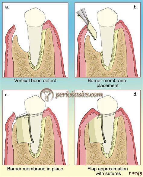 guided regeneration procedure.